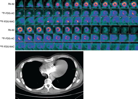 lexiscan nuclear stress test soft tissue attenuation|attenuation artifact test.